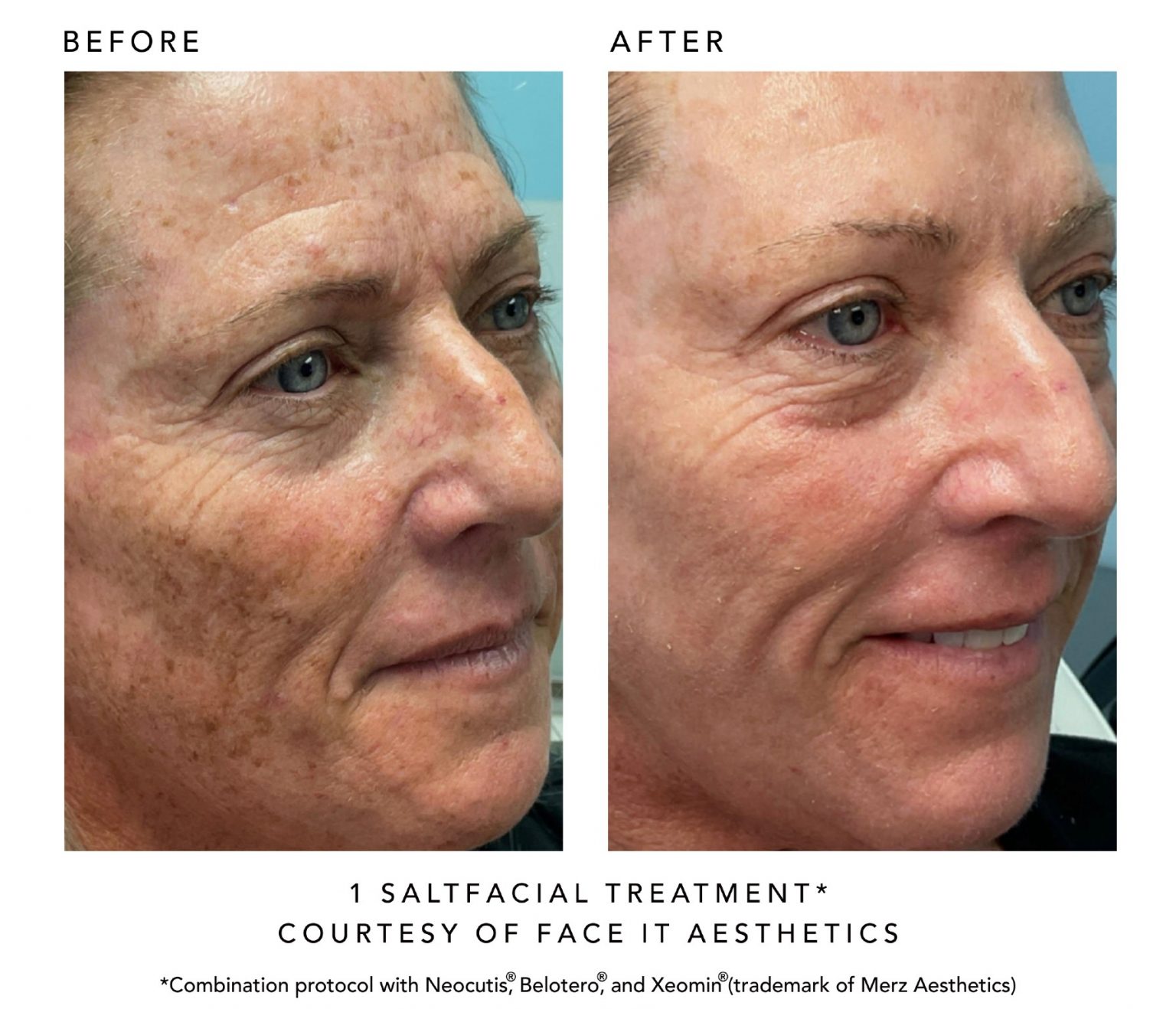 SaltFacial_BeforeAfter_Cropped3-1536×1318